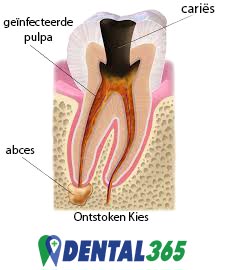 ontstoken kies of tand heeft wortelkanaalbehandeling nodig om deze te redden. Niet trekken van een tand of kies.