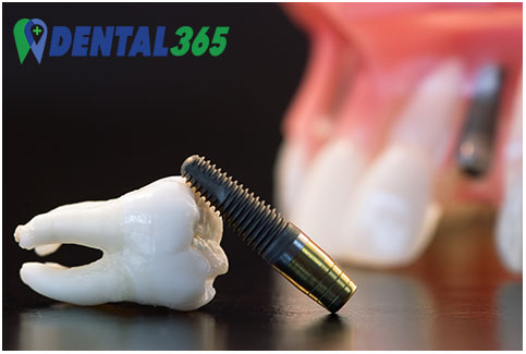 uitgevallen vulling of kroon - tandimplantaat ter vervanging van missende tand of kies - dental 365