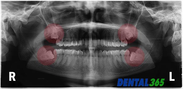 Help Mijn Verstandskiezen Moeten Eruit! Wat Nu? - Dental365.Nl