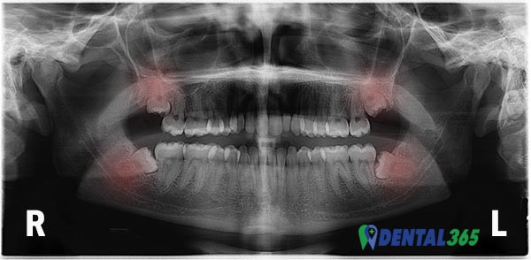 impacted wisdom teeth, ontstoken verstandskies wat te doen, dental365 spoed tandarts