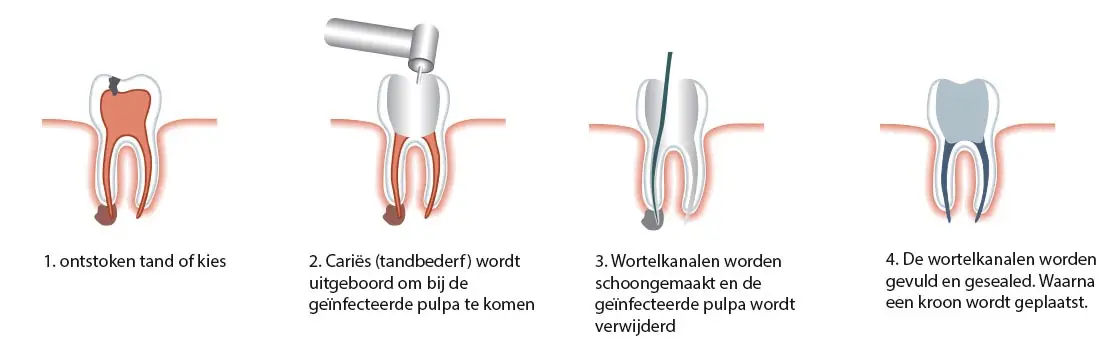 wortelkanaalbehandeling versus tandextractie - wat is te overwegen?