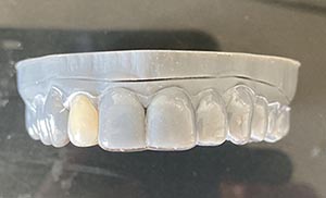 essix retainer essix beugel bij missende tanden dental365 300x