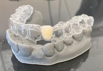 essix retainer essix beugel bij missende tanden orthodontie dental365