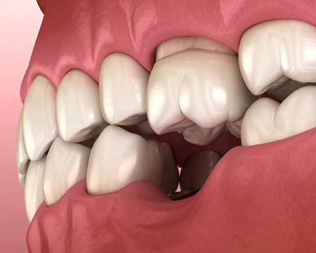 tanden verschuiven na extractie - essix beugel of retainer als tijdelijke oplossing