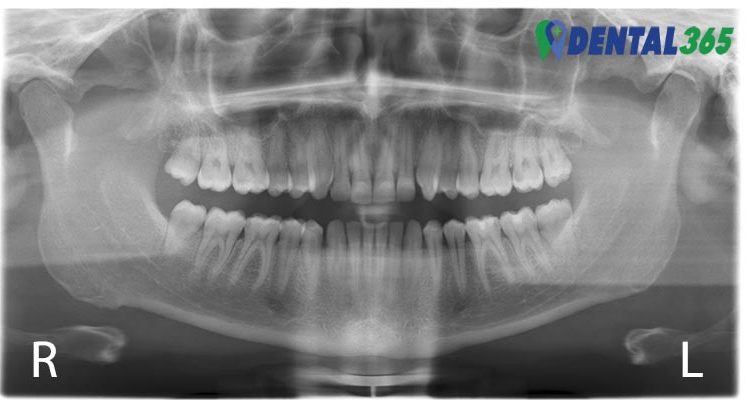 waarom maakt de spoed tandarts een röntgenfot zoals een OPG, ook wel kaakoverzichtsfoto genoemd.