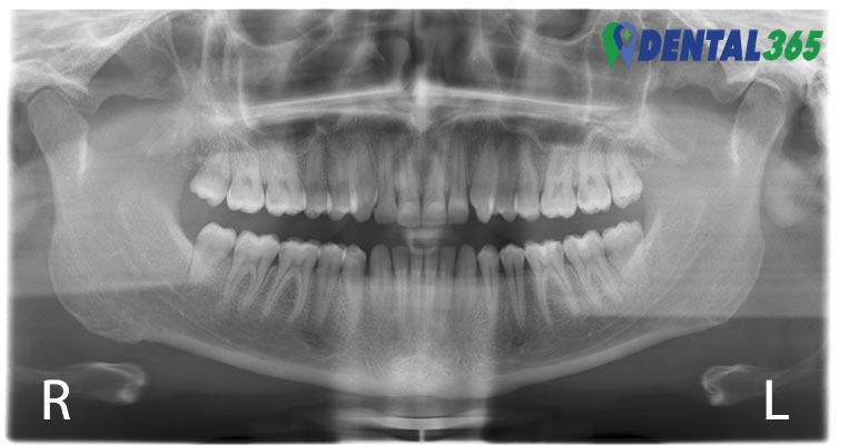 waarom maakt de spoed tandarts een röntgenfot zoals een OPG, ook wel kaakoverzichtsfoto genoemd.